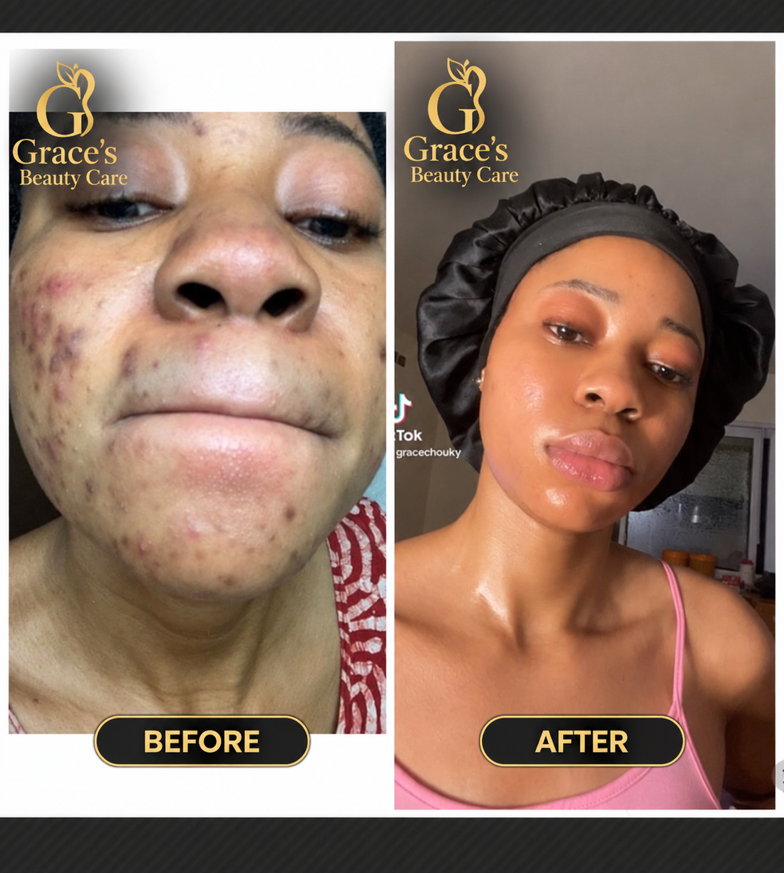 Complete acne and dark spot remedies kit